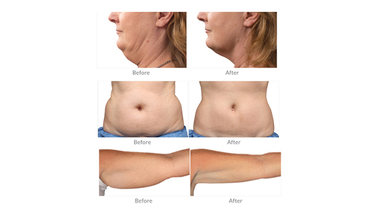 precio de la máquina de criolipólisis