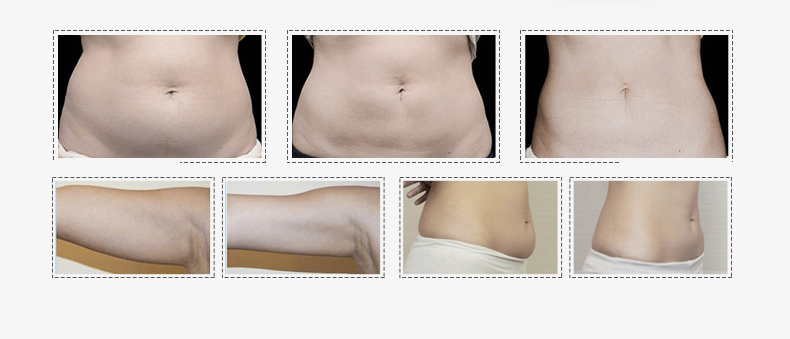 Cryolipolysis Slimming Machine Máquina de adelgazamiento por criolipólisis