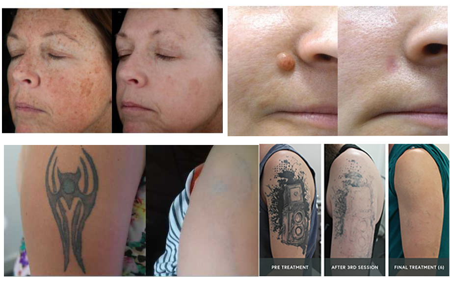 eliminaci&oacute;n de tatuajes