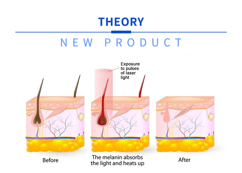 m&aacute;quina de depilaci&oacute;n