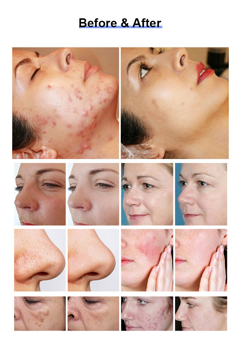 1927nm l&aacute;ser fraccional