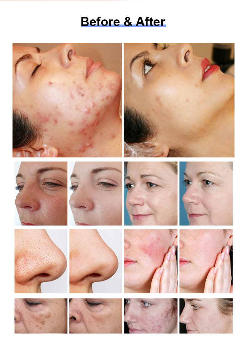 1927nm l&aacute;ser fraccional