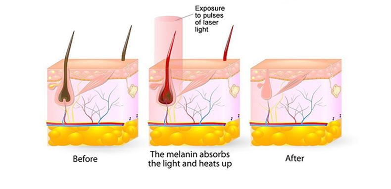 m&aacute;quina de depilaci&oacute;n l&aacute;ser