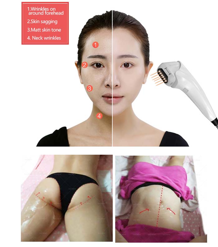 M&aacute;quina de estiramiento facial Hifu