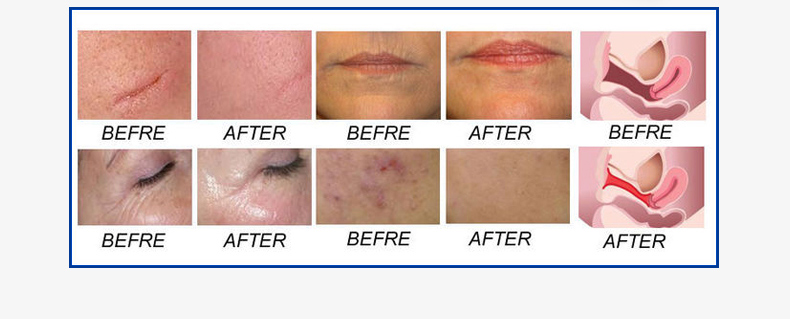 M&aacute;quina l&aacute;ser fraccional de CO2 profesional