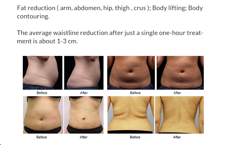 M&aacute;quina de adelgazamiento corporal Hifu Liposonix