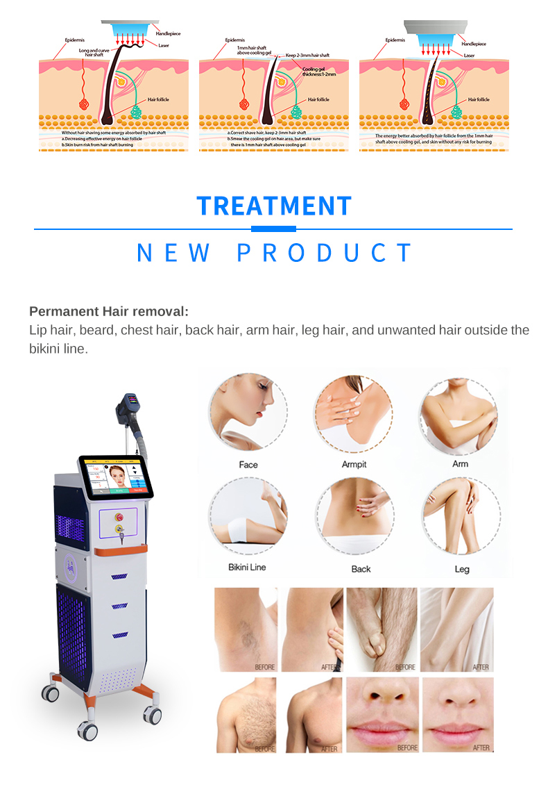 Depilaci&oacute;n L&aacute;ser de Diodo