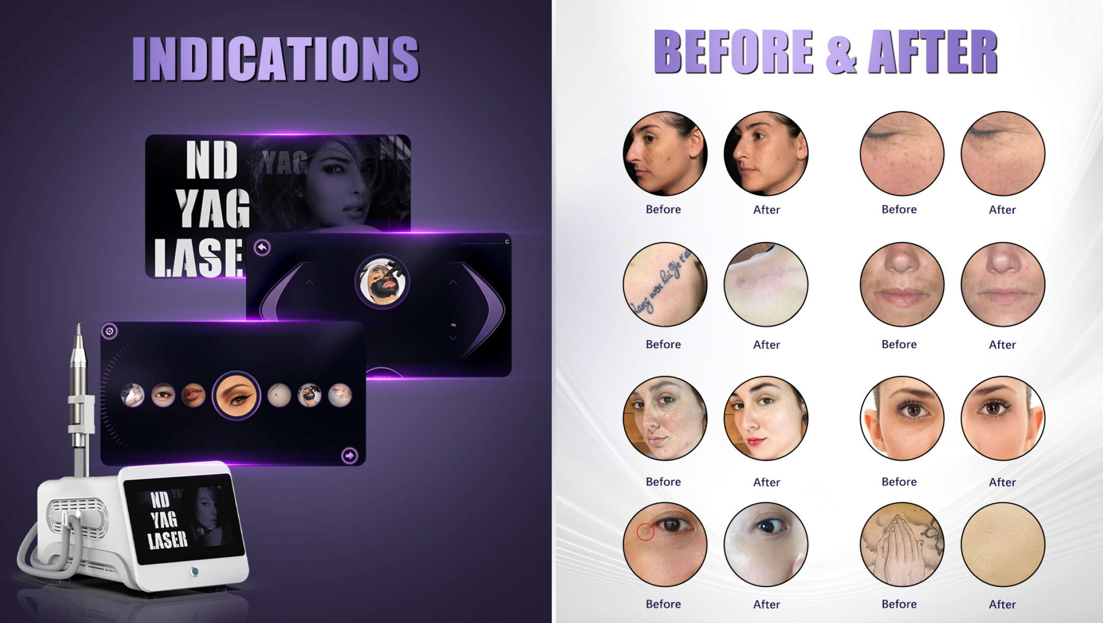 m&aacute;quina Picolaser