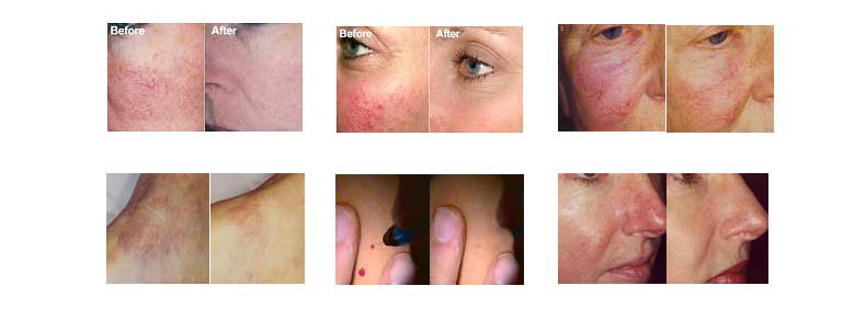 remoci&oacute;n vascular