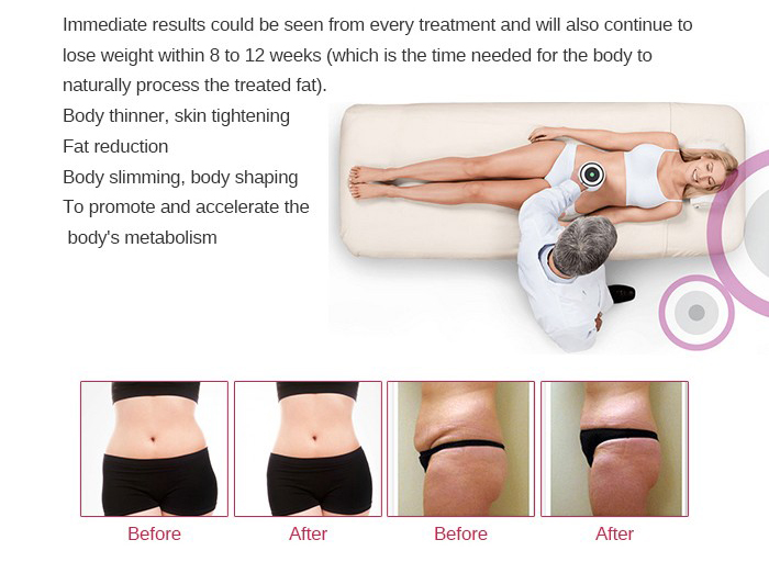 UltraShape adelgazante