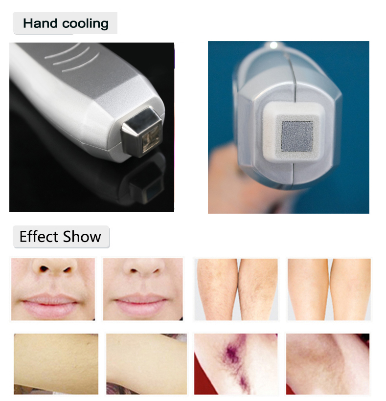 la depilaci&oacute;n l&aacute;ser