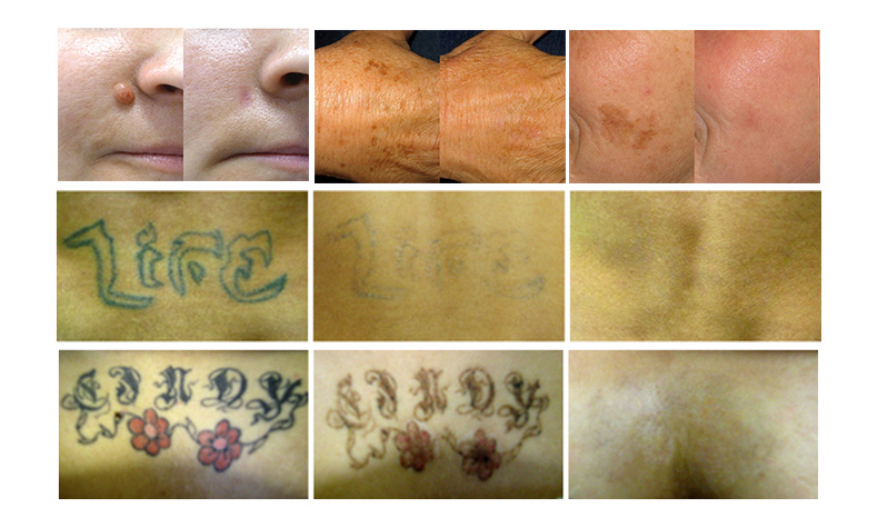 m&aacute;quina de extracci&oacute;n de tatuajes