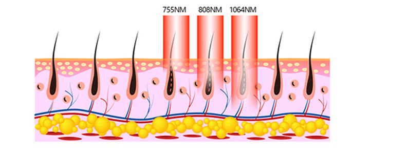 Teor&iacute;a de las m&aacute;quinas de depilaci&oacute;n