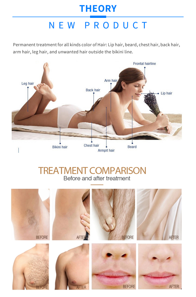 m&aacute;quina de depilaci&oacute;n l&aacute;ser