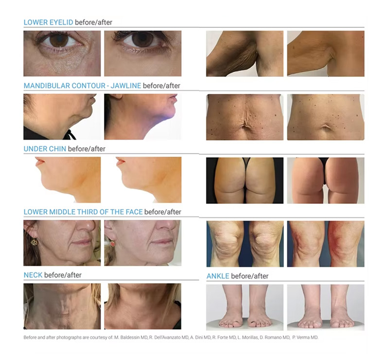 m&aacute;quina de lip&oacute;lisis l&aacute;ser de diodo