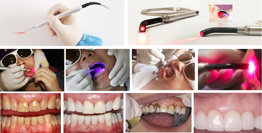 cabezales de tratamiento