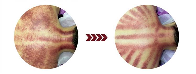 m&aacute;quina de vac&iacute;o de cavitaci&oacute;n