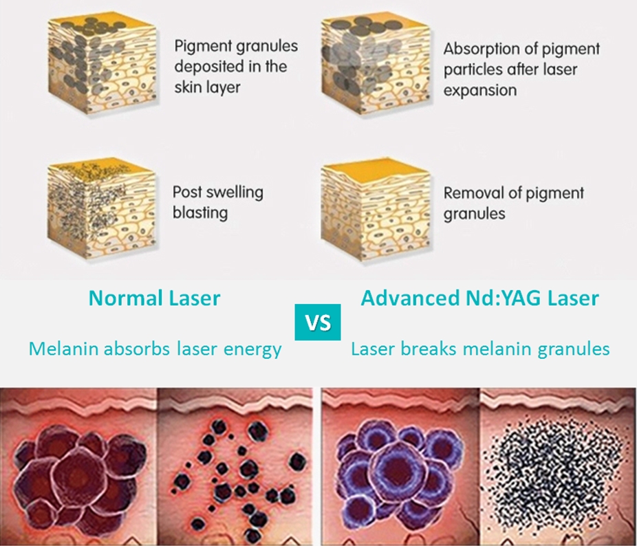 eliminaci&oacute;n de pigmentos