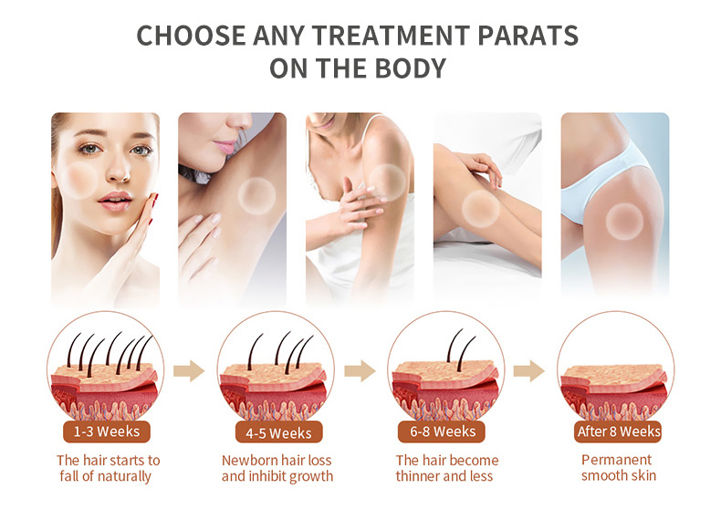 808 M&aacute;quina de depilaci&oacute;n