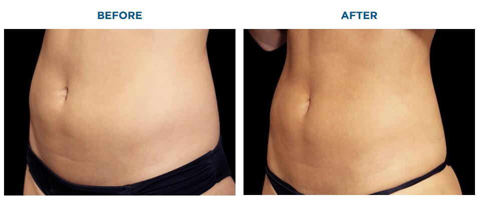 m&aacute;quina para perder peso