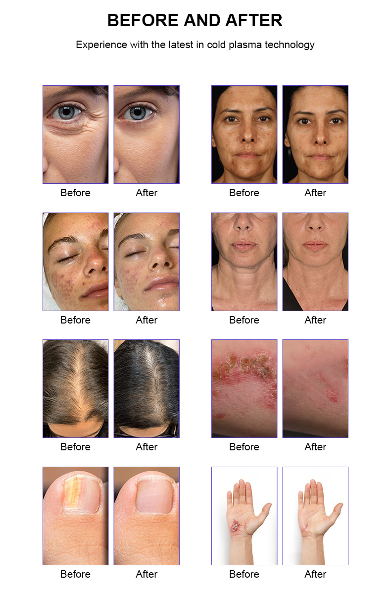 M&aacute;quina de plasma fr&iacute;o