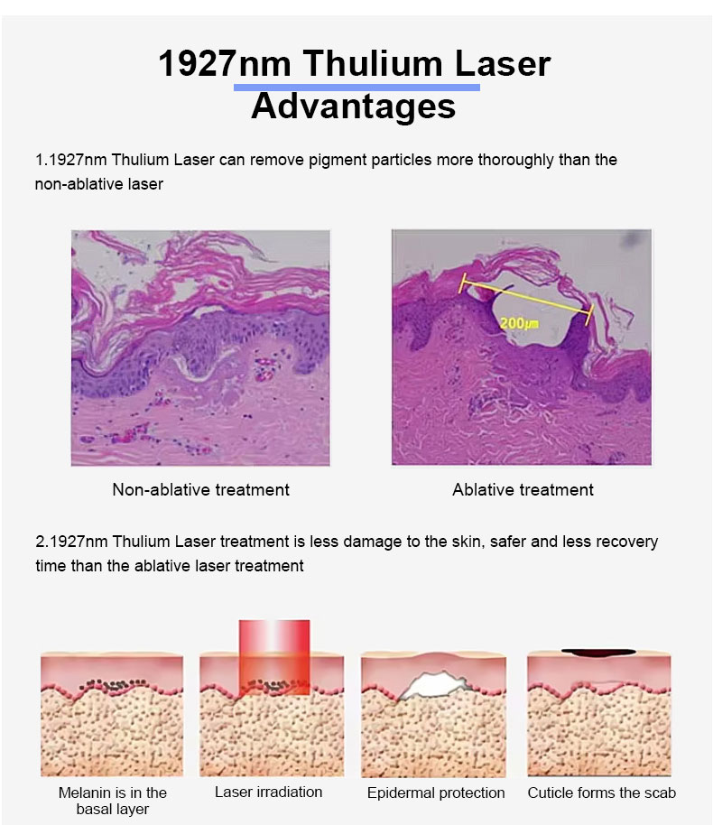 1927nm thulium l&aacute;ser fraccional