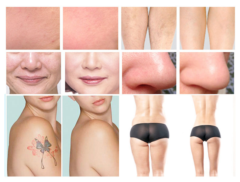 E-light + L&aacute;ser NdYAG+lipolaser+RF