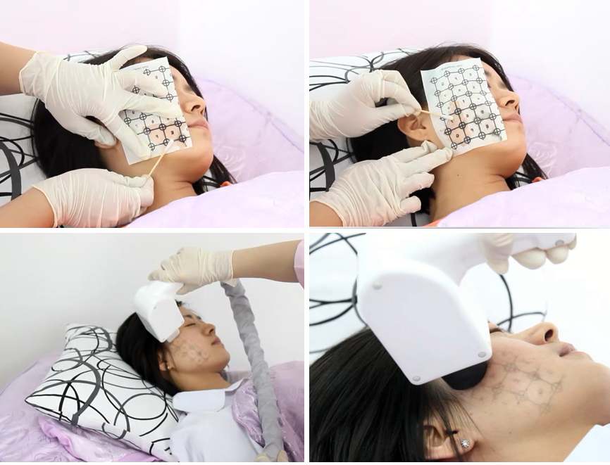 tratamiento cl&iacute;nico termage