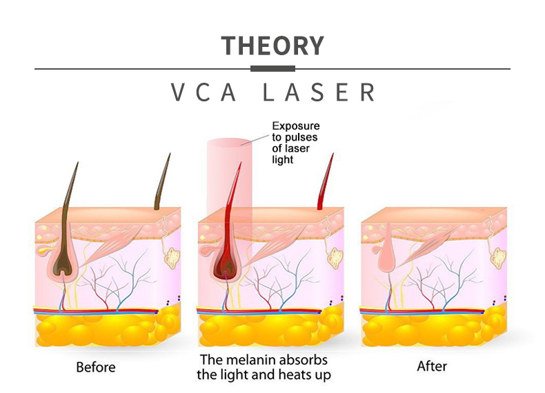 La depilaci&oacute;n l&aacute;ser