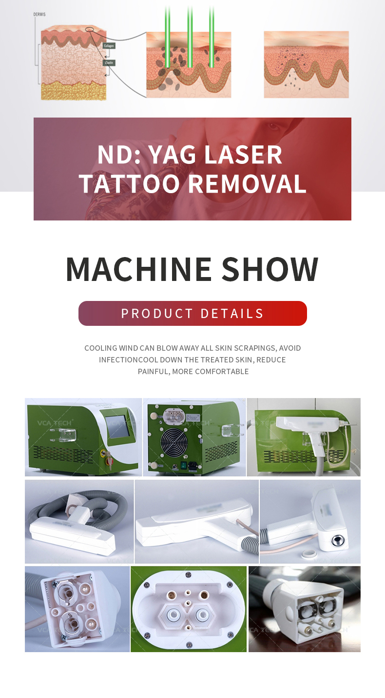 m&aacute;quina de eliminaci&oacute;n de tatuajes 