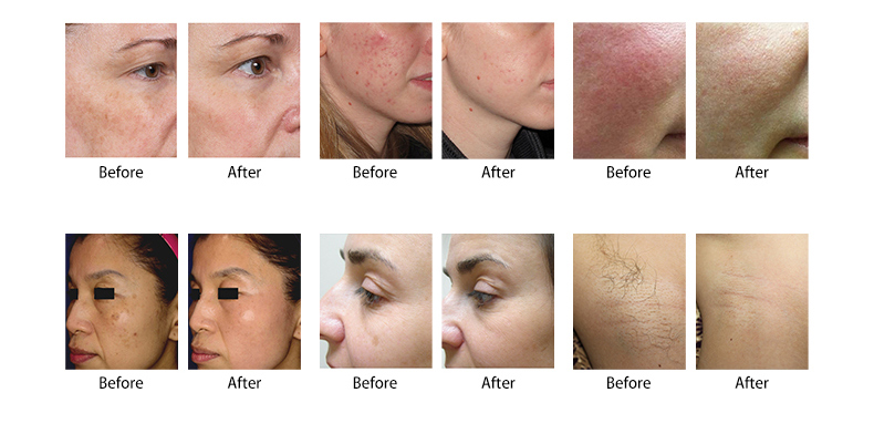 M&aacute;quina de rejuvenecimiento de la piel