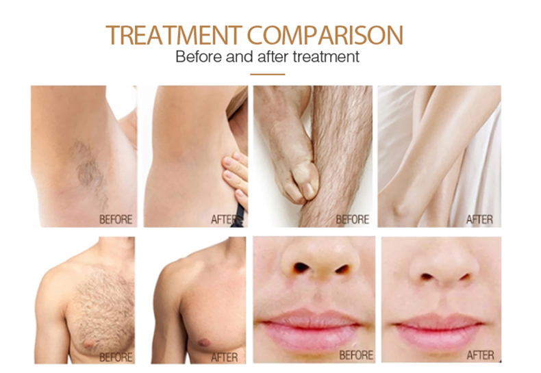 M&aacute;quina de diodo de depilaci&oacute;n l&aacute;ser