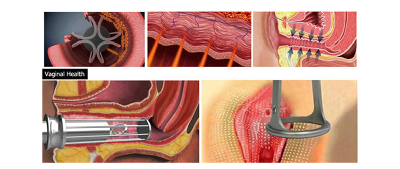 M&aacute;quina l&aacute;ser fraccional de CO2 profesional