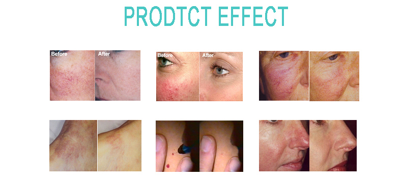 M&aacute;quina de eliminaci&oacute;n de ara&ntilde;as vasculares