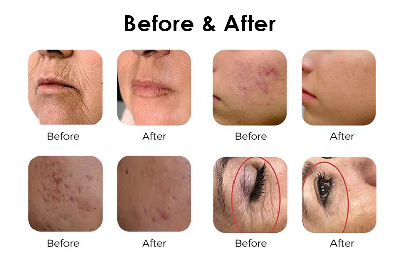 1550 nm de vidrio Erbium&nbsp; L&aacute;ser&nbsp;