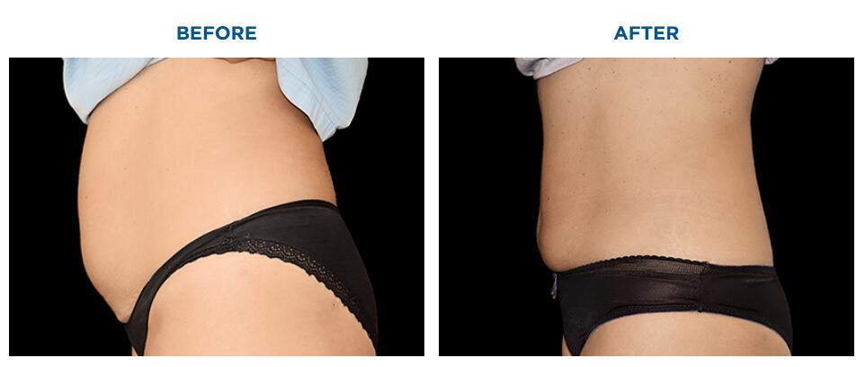 m&aacute;quina para perder peso