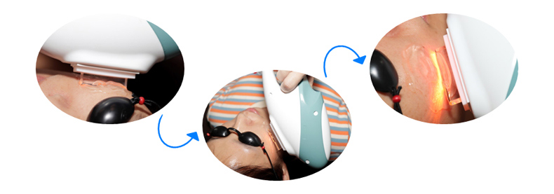 La mejor m&aacute;quina blanqueadora efectiva