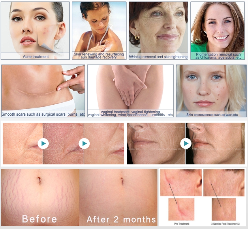 L&aacute;ser co2 fraccionado