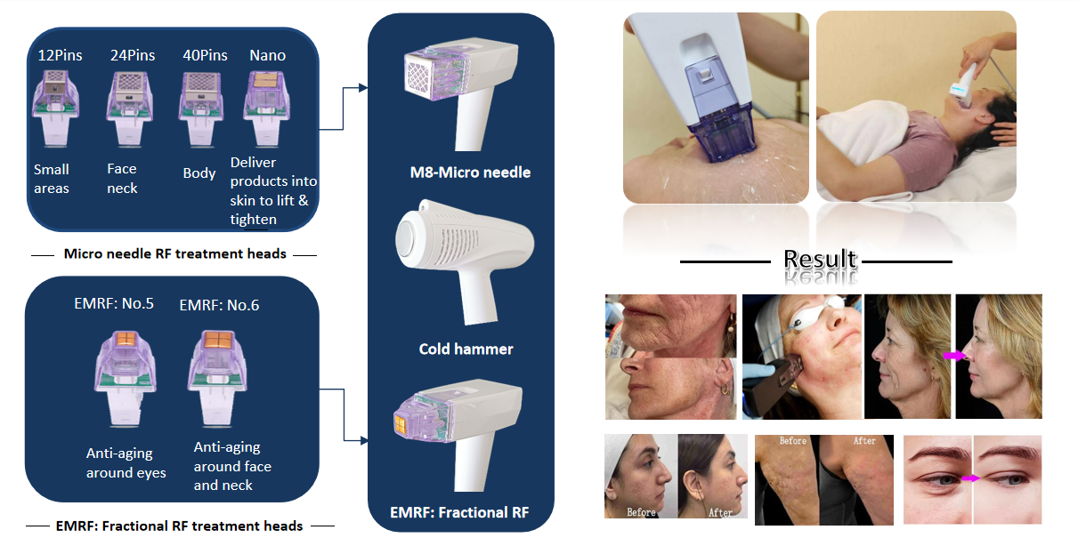 M&aacute;quina de micro aguja