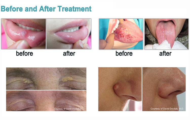 estiramiento vaginal co2 fraccional