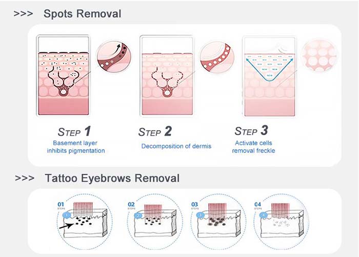 l&aacute;ser de picosegundo