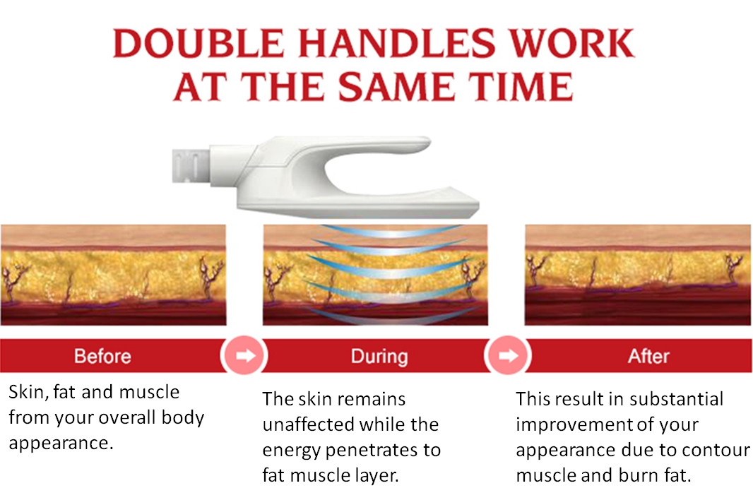 M&aacute;quina de esculpir EMS