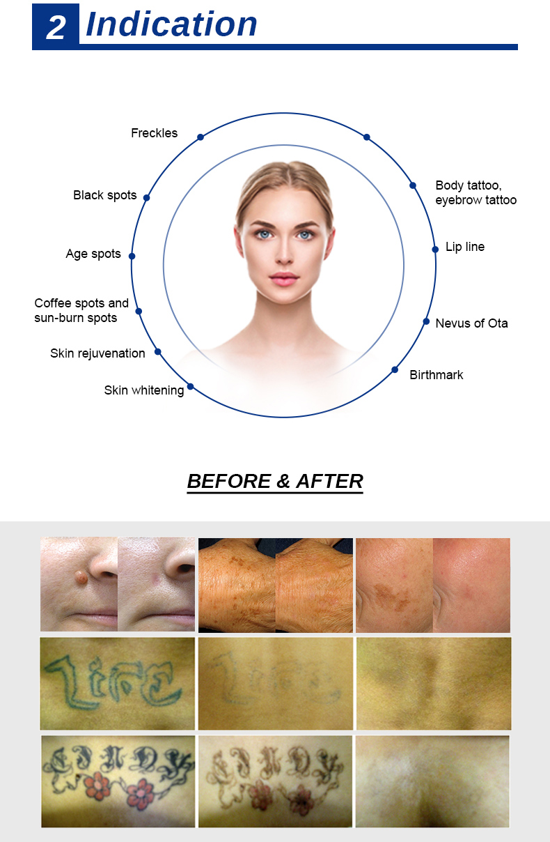 Remoci&oacute;n del tatuaje l&aacute;ser