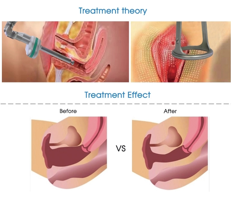 l&aacute;ser de estiramiento vaginal