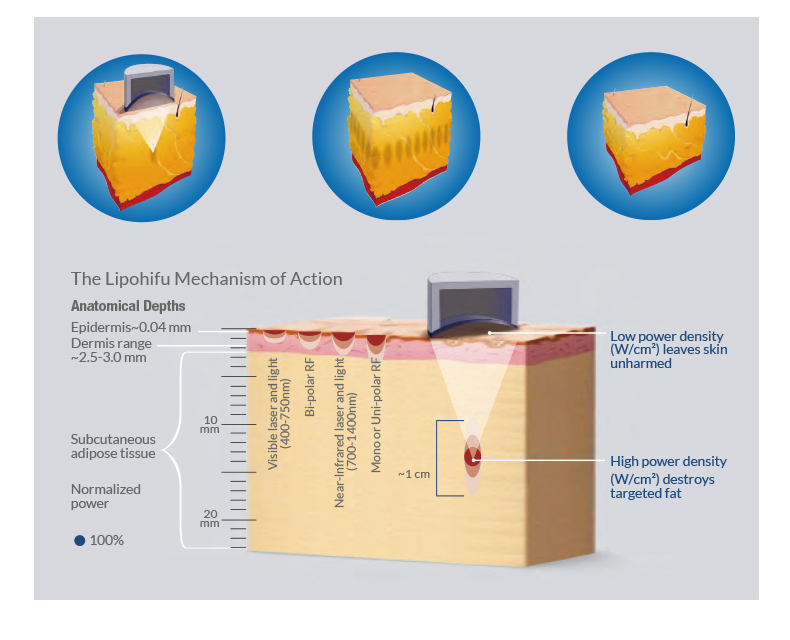 M&aacute;quina de adelgazamiento corporal Hifu Liposonix