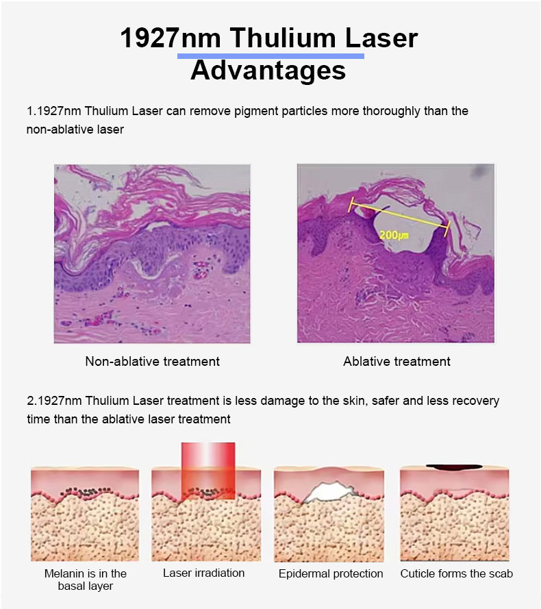 1927nm l&aacute;ser fraccional