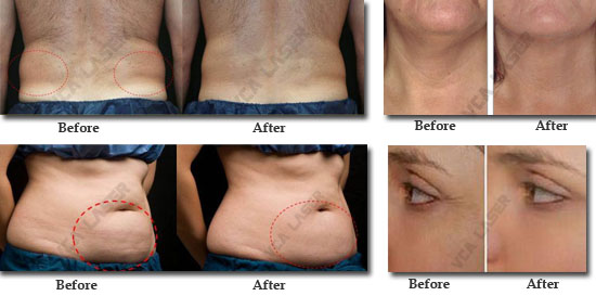 tratamiento-MARK550(6)