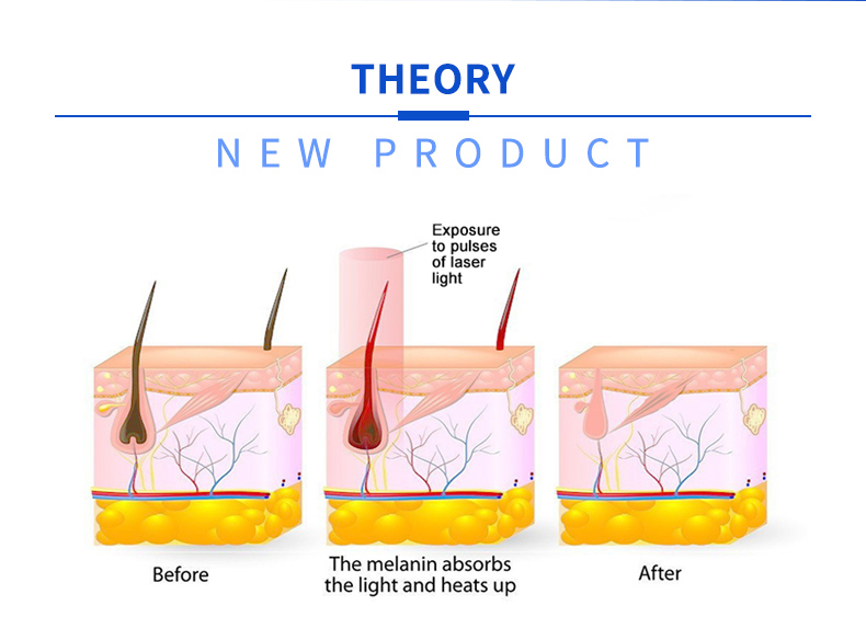 m&aacute;quina de depilaci&oacute;n