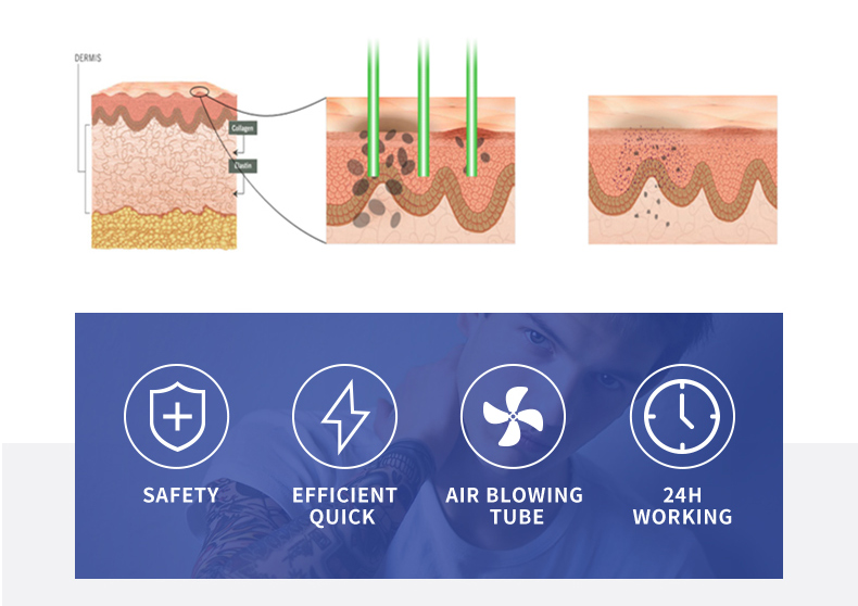 m&aacute;quina de extracci&oacute;n de tatuajes