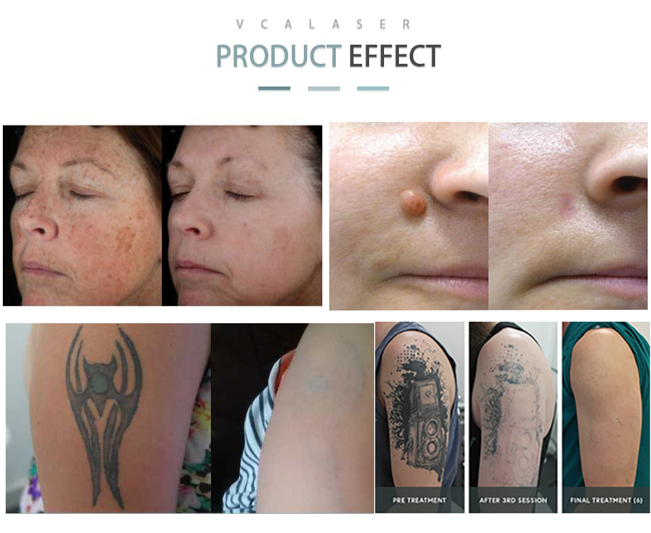 l&aacute;ser de picosegundo